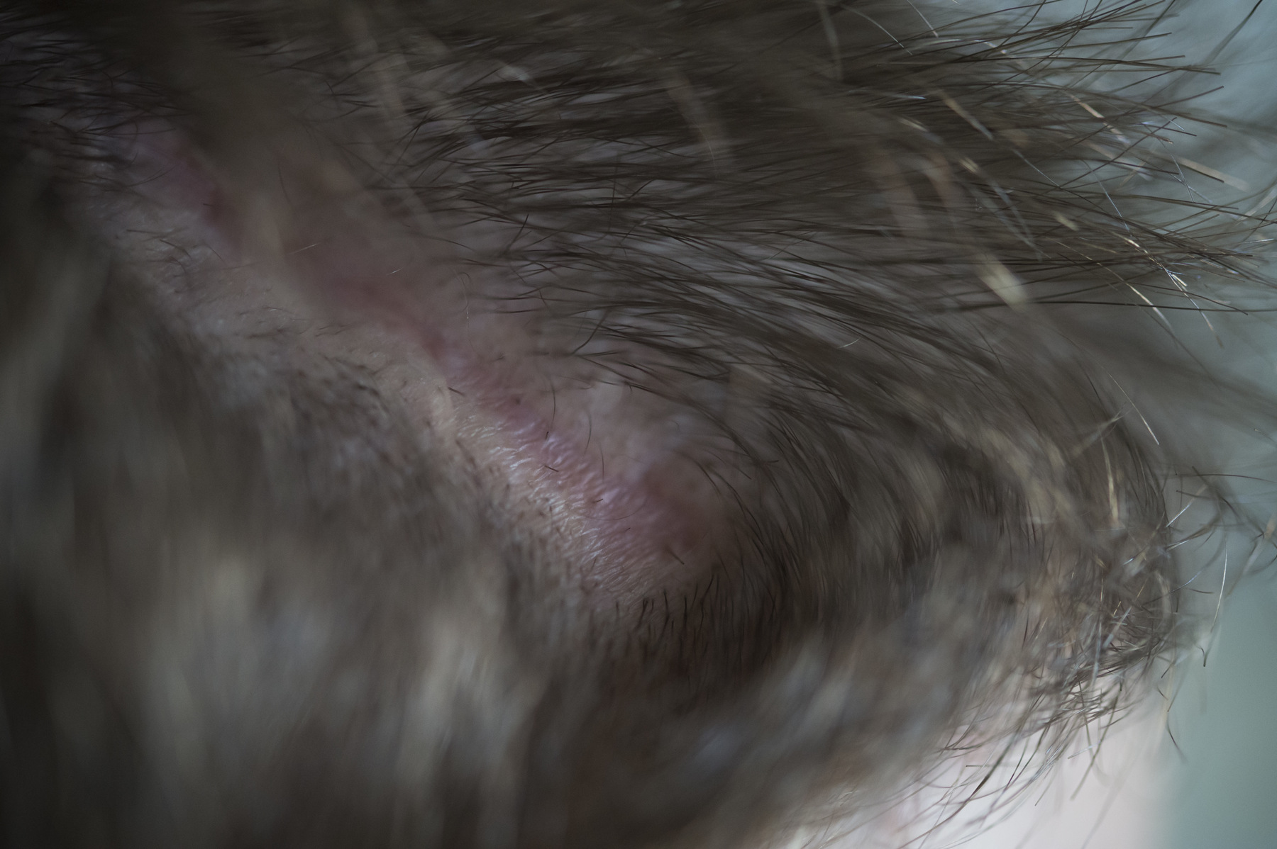 Photographer Anna Tärnhuvud - Acute CT scans shows traumatic bleeding centrally in the right cerebrum and blood in the brains right cavities. A number of rib fractures. Bone damage is seen on the left leg and on the collarbone and left shoulder. Open wounds on the left arm and leg, as well as on the skull.” Notes from the hospital. 