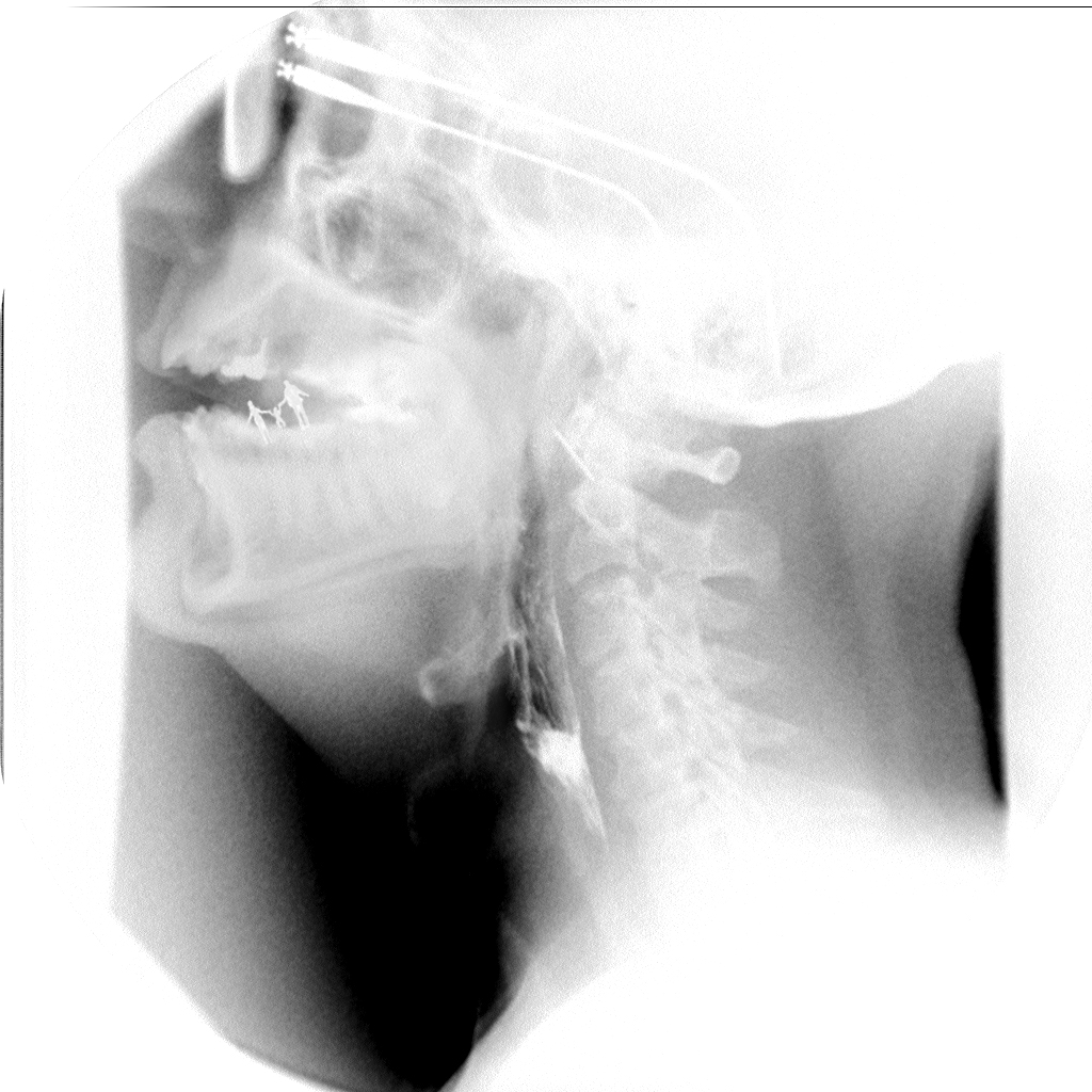 SMALL SWALLOWED SAVIOURS X-RAY ART